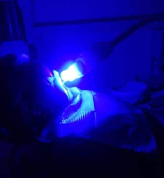 Blanqueamiento de Dientes con laser