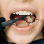 ¿Qué es y cómo evitar la caries dental?