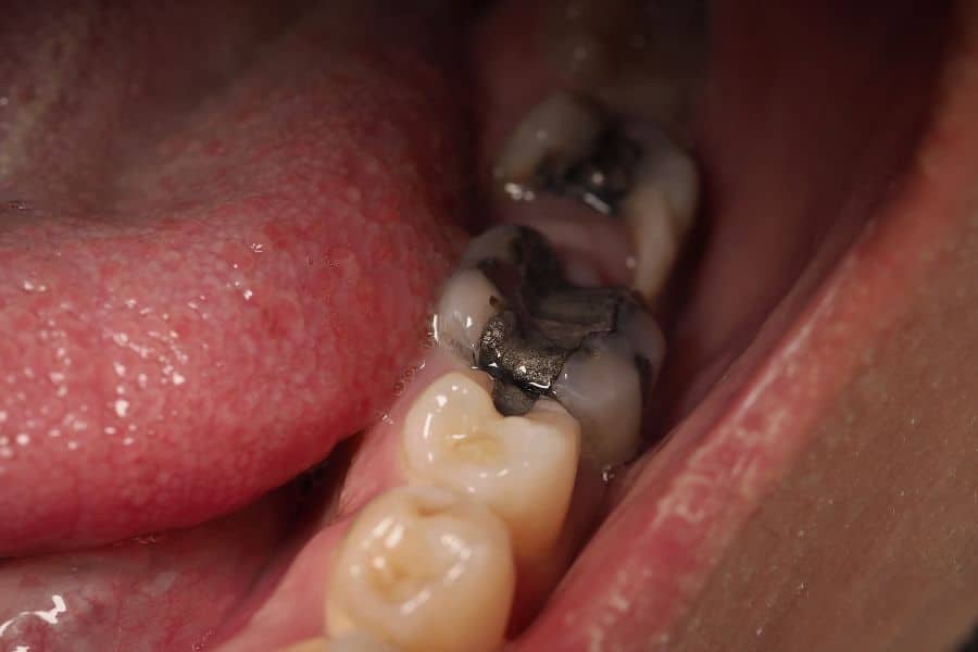 amalgama-dental